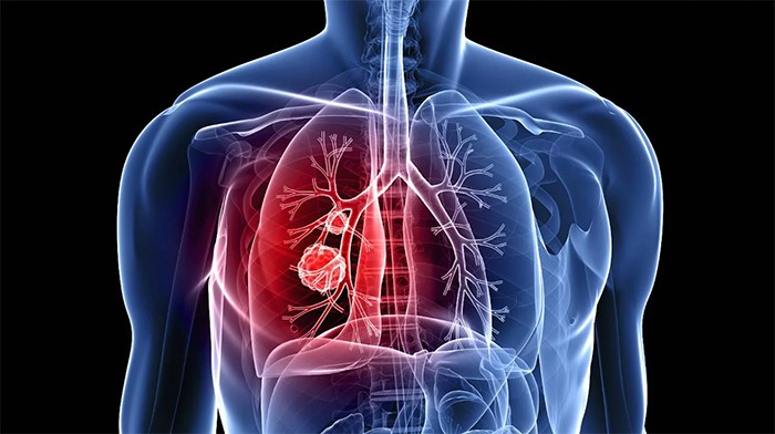 Una nueva terapia utiliza nanopartículas contra la fibrosis pulmonar 