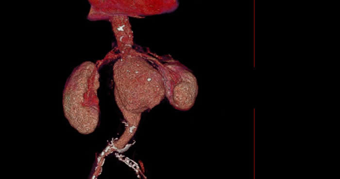 Webinar Diagnóstico por Angiotomografía de la Patología de Aorta 