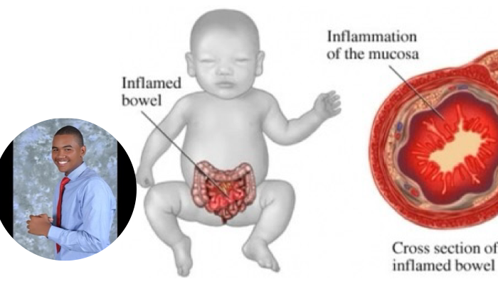 Enterocolitis necrosante 