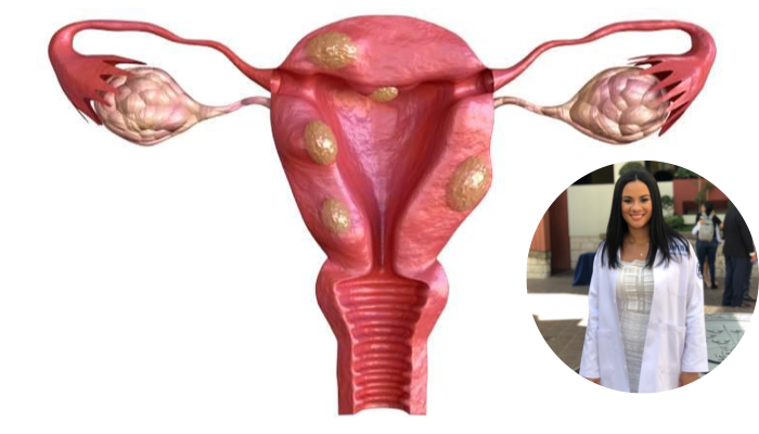 Fibromas uterinos 