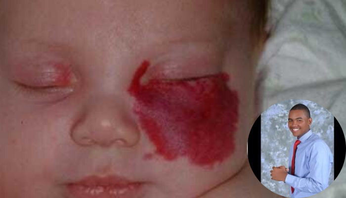 Hemangiomas Infantiles 