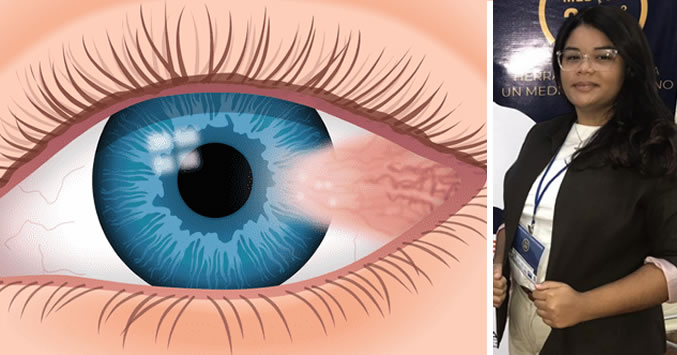 Pterigium 