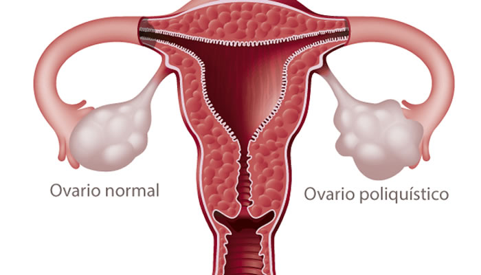 Síndrome de Ovario Poliquístico 