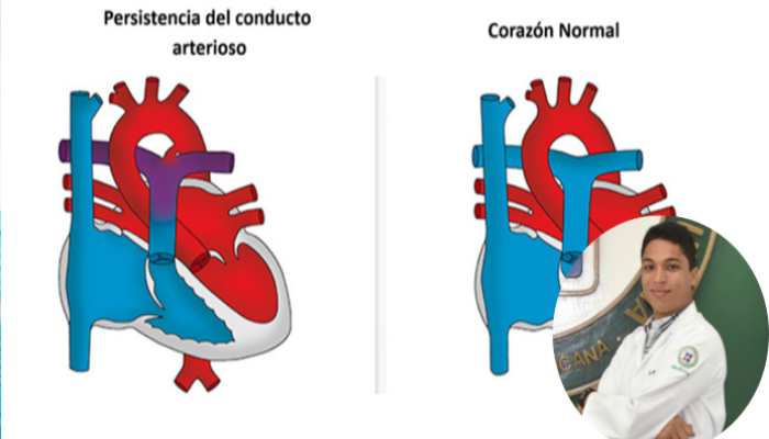 Persistencia del Conducto Arterioso 