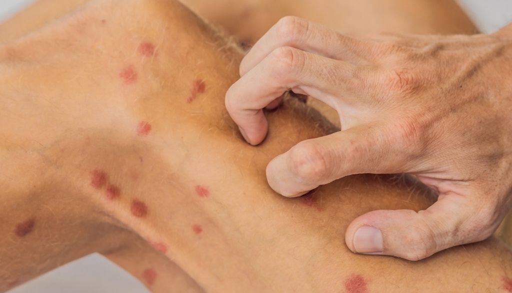 Prestar atención a la piel es clave para detección temprana de lepra 