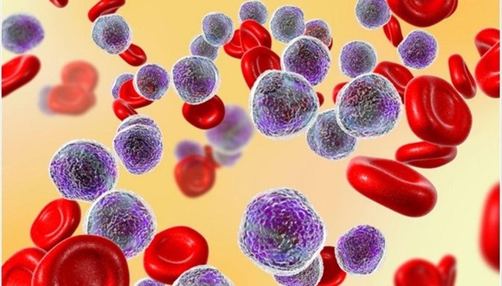 Nuevos avances sobre el origen de la leucemia linfoblástica aguda en niños 