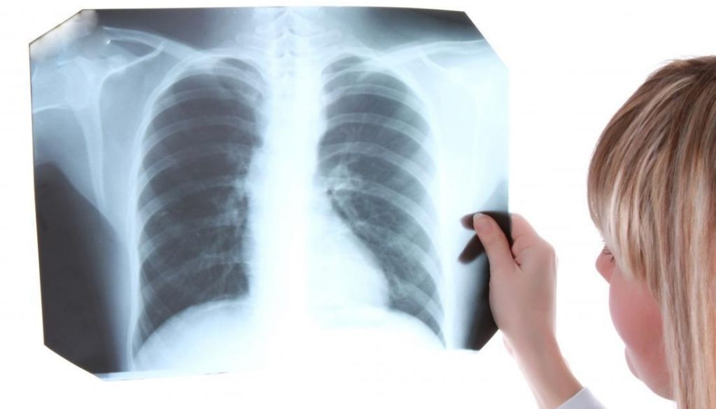 Desarrollan método acelera diagnóstico de la tuberculosis 