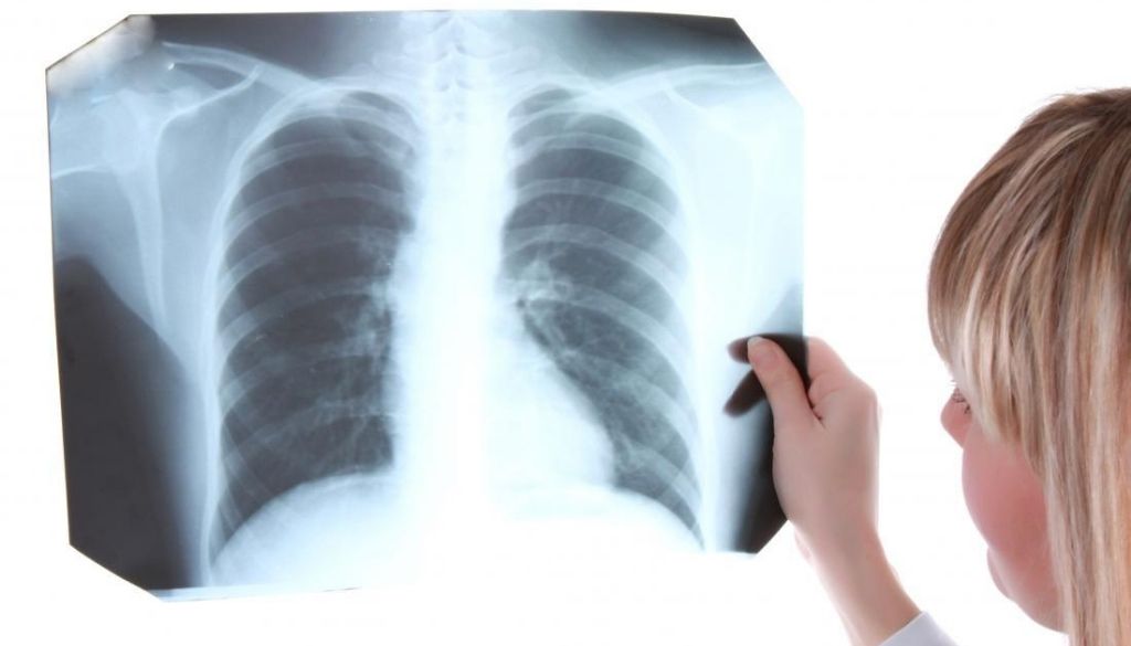 OMS asegura atención para tuberculosis disminuyó 21% durante la pandemia 