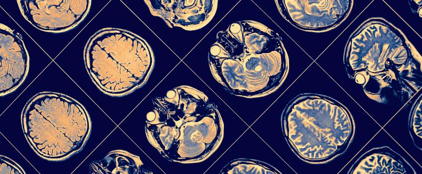 Una mutación del párkinson desvía el hierro en el cerebro 