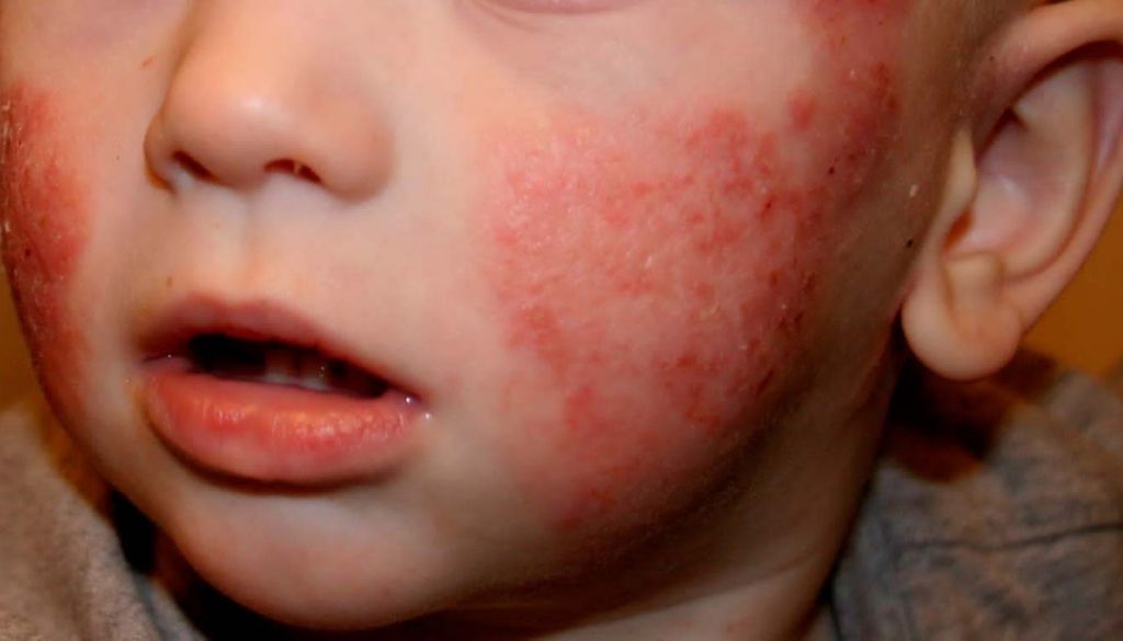 Especialista destaca características de la dermatitis atópica en la infancia  