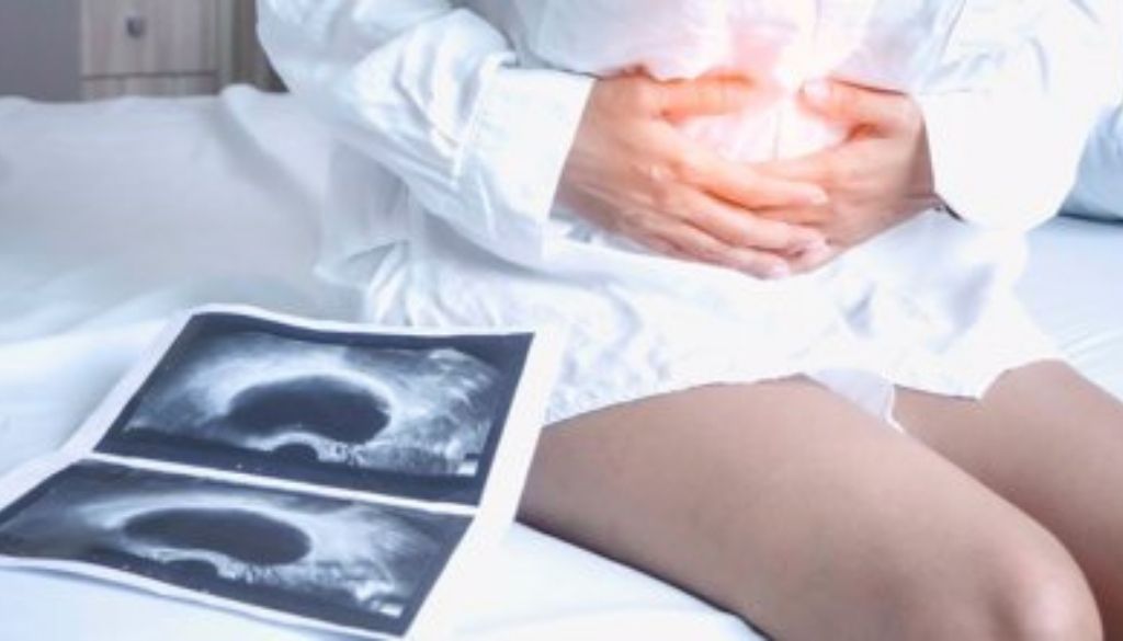 Investigadores identifican origen genético de la endometriosis 