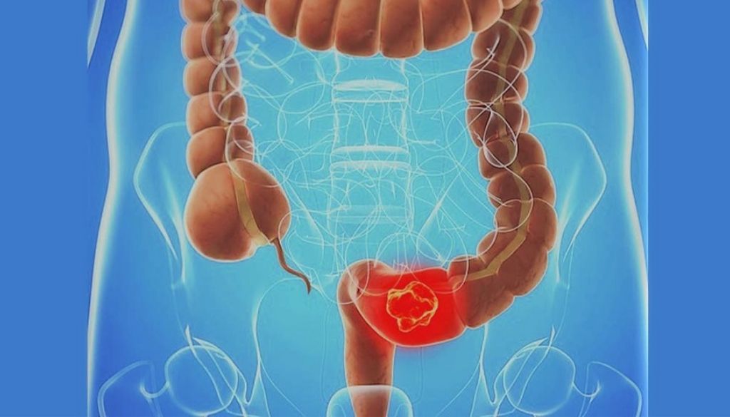 Vitamina D puede ser determinante en riesgo sufrir cáncer colorrectal 