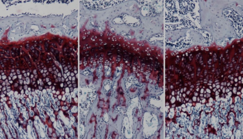 Desarrollan terapia génica podría curar enfermedad de Morquio A 