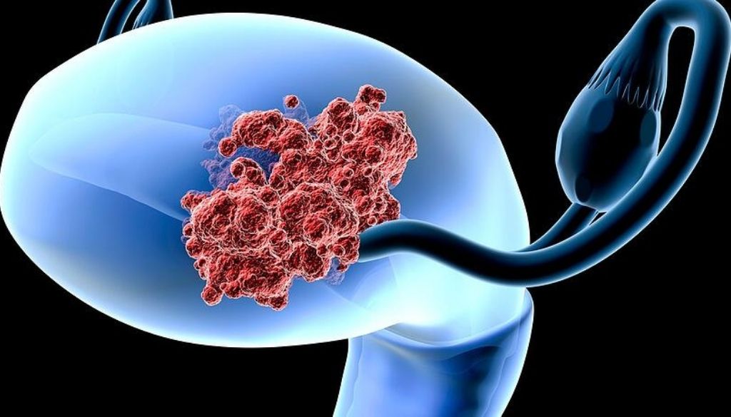 Prevén 410.000 muertes anuales por cáncer de cuello uterino para 2030 