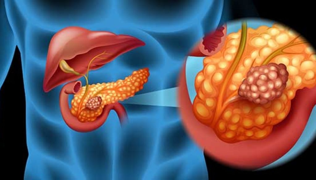Terapia ultrasónica: nueva esperanza contra el cáncer de páncreas 