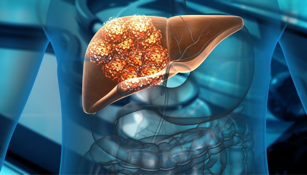 Una nueva diana terapéutica podría reducir la resistencia a la quimioterapia en cáncer de hígado 