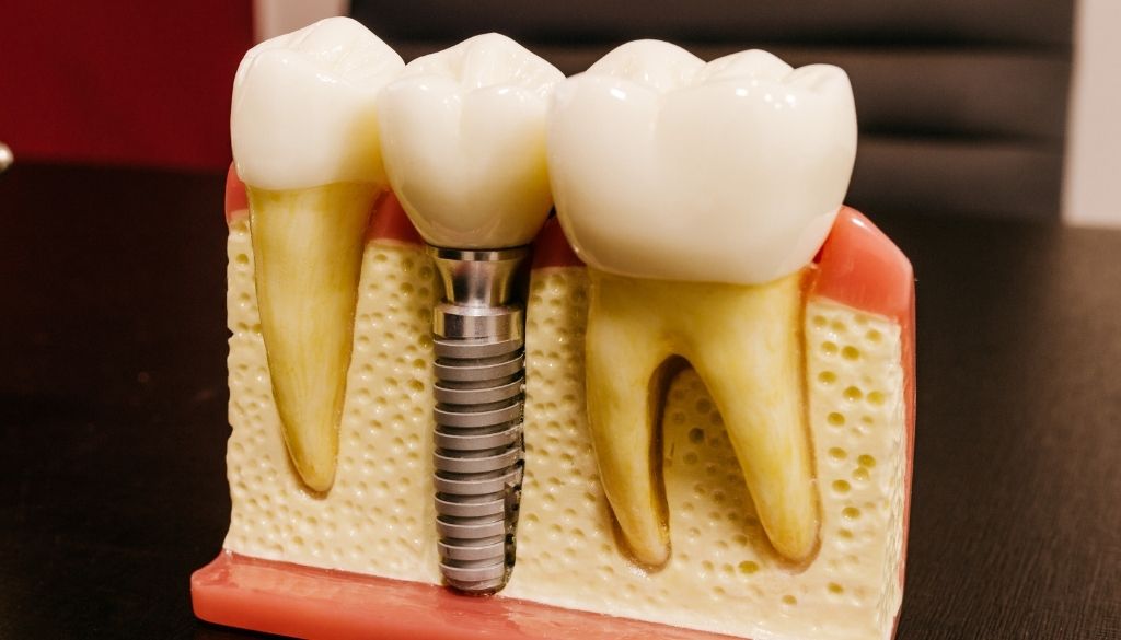 Crean implante dental inteligente resistente a crecimiento bacteriano 
