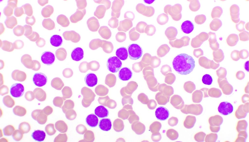 Definida nueva variable para evaluar pronóstico de leucemia linfática crónica 