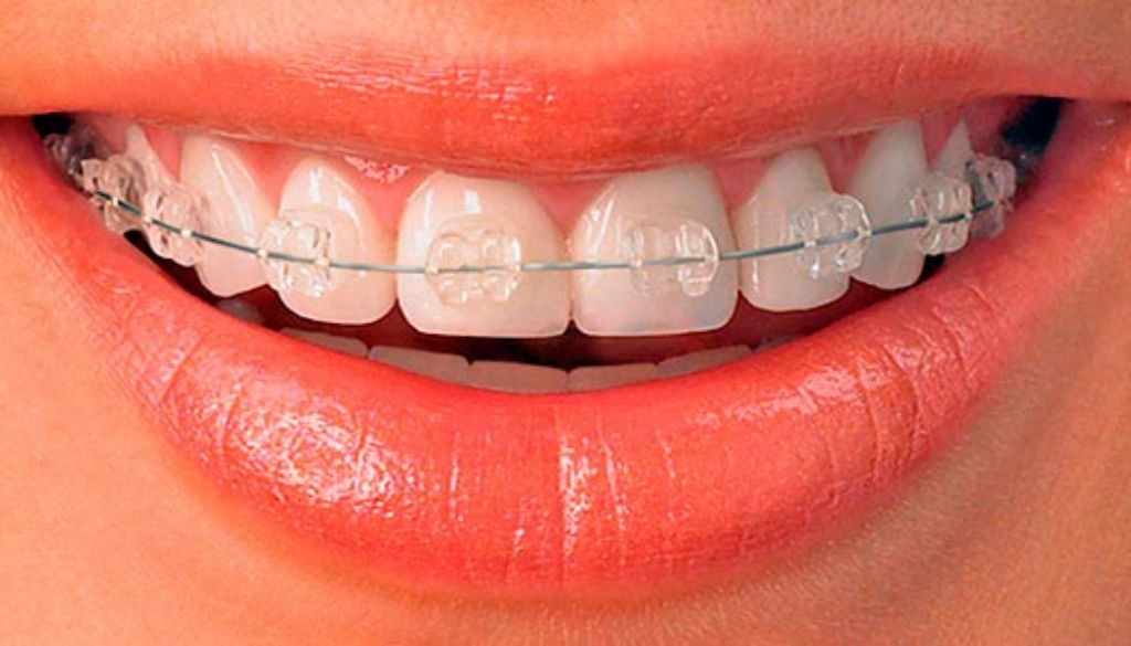 Demuestran influencia de ligaduras en ortodoncia fija sobre pH salival 