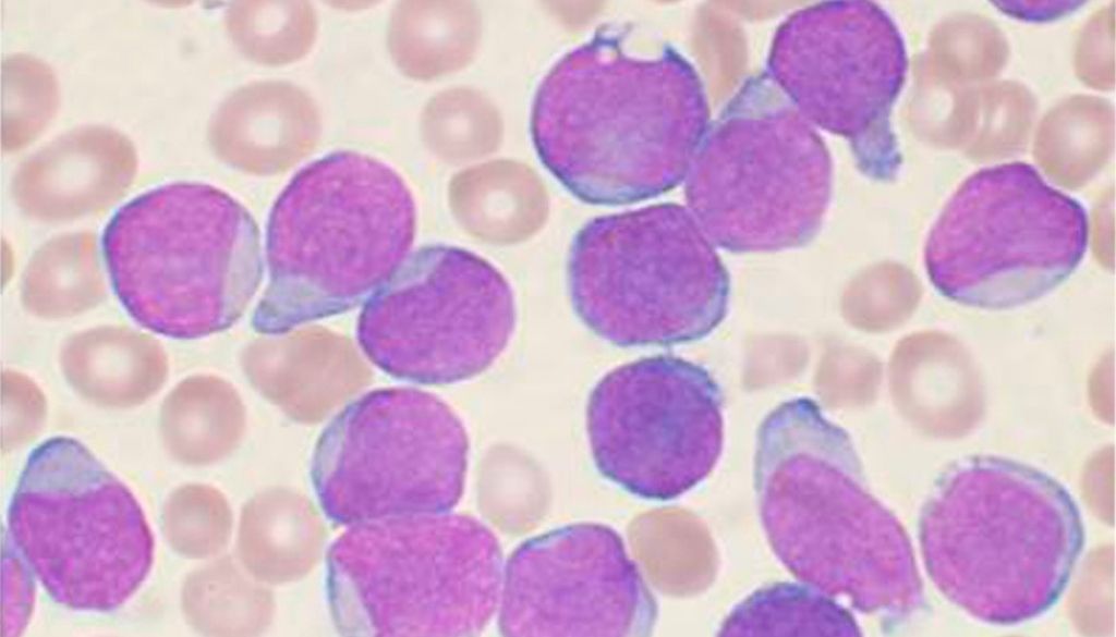 Identificado un nuevo mecanismo de migración celular utilizado por las células de leucemia 