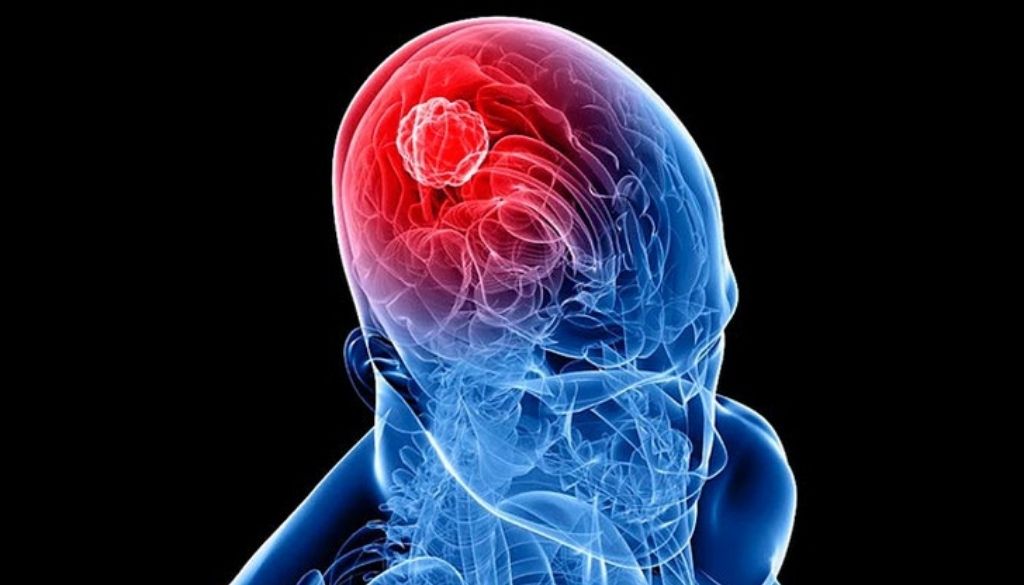 Terapia combinatoria experimental logra eliminar tumor cerebral incurable 