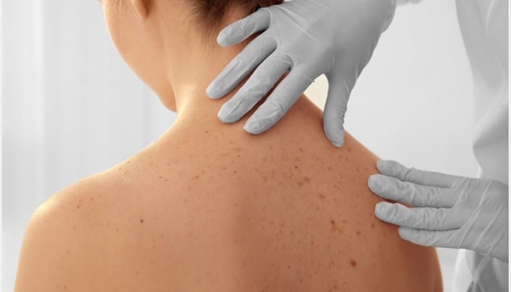 Alertan mayor incidencia cáncer de piel en mujeres - DiarioSalud.do