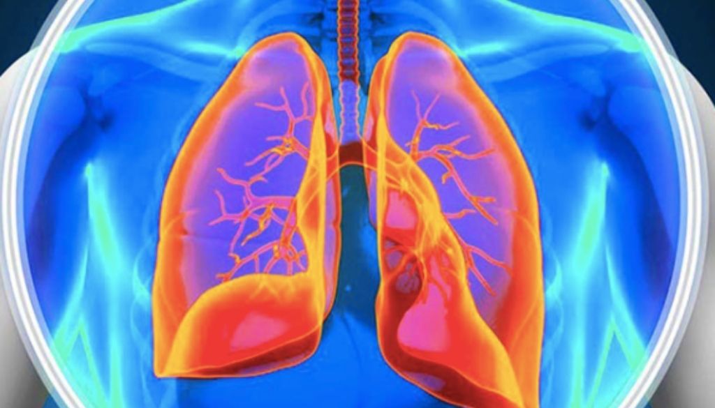 Presentan nuevas estrategias para tratar el enfisema pulmonar: avances en fisioterapia, cirugía y válvulas endobronquiales 