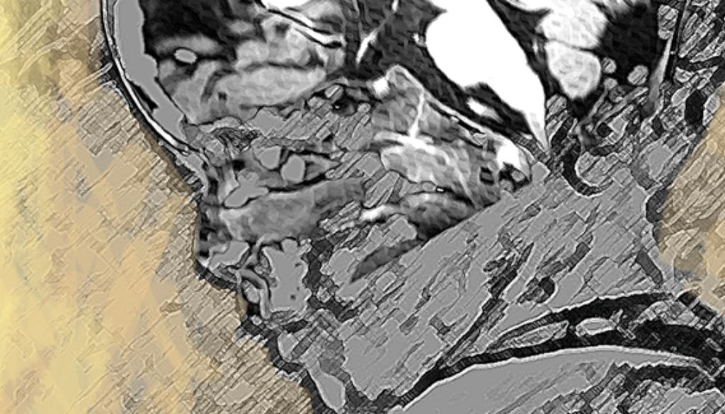 Identifican un gen causante de un nuevo síndrome neurológico y óseo 