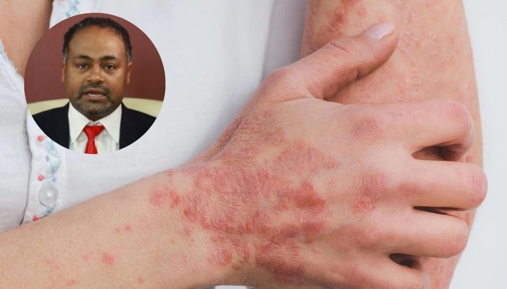 <strong>Recomiendan autoridades realicen inspecciones por infección similar a sarna</strong> 