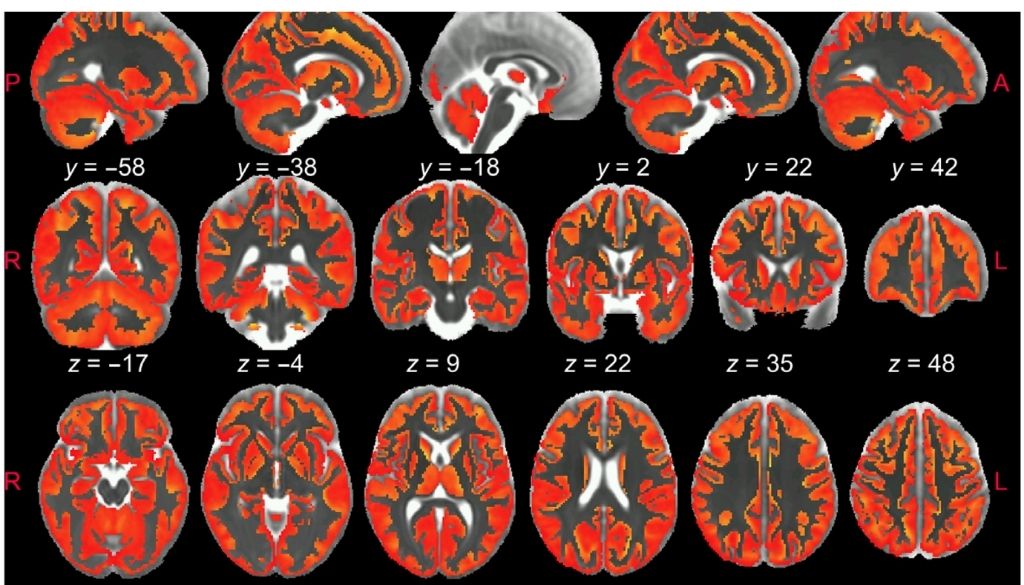 Resonancia magnética permite ver inflamación del cerebro ‘in vivo’ 