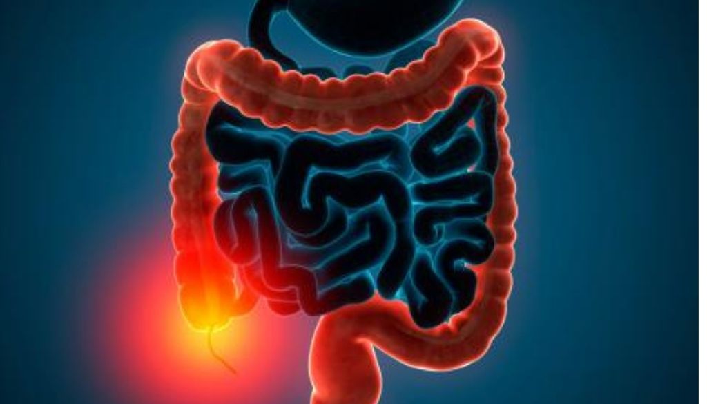 Colitis ulcerosa: retos que enfrentan quienes la padecen 