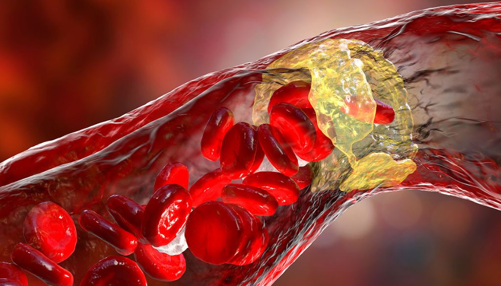 Combinación dos proteínas inflamatorias predice  pronóstico en enfermedad cardiovascular 