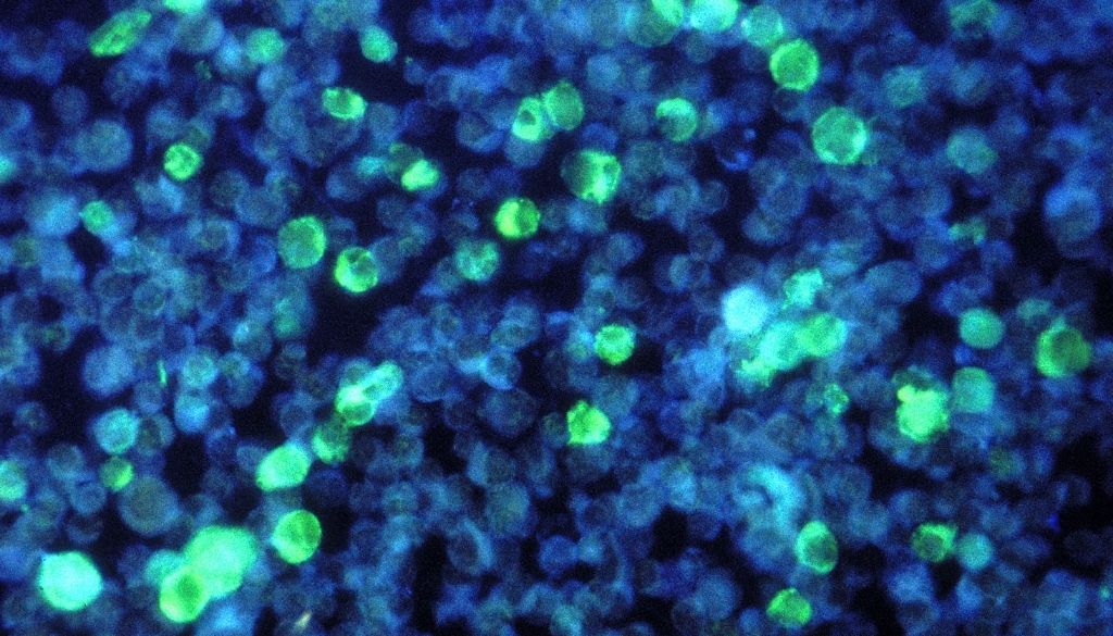Descifrado mecanismo molecular de enfermedad rara que causa inmunodeficiencias graves 