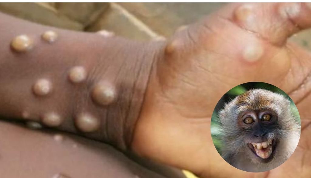 Expertos plantean la hipótesis de que la viruela del mono se transmita sexualmente 