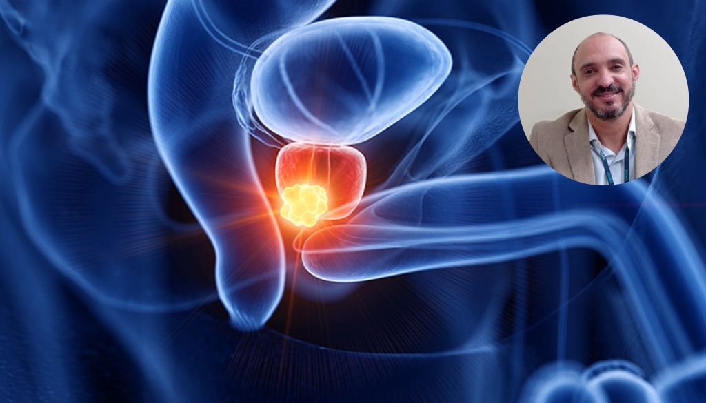 Urólogo llama realizarse chequeos para descartar cáncer de próstata 