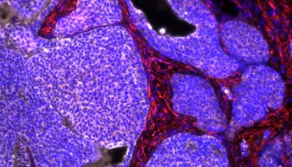 Diseñan nanopartículas mejoran terapias contra el cáncer 