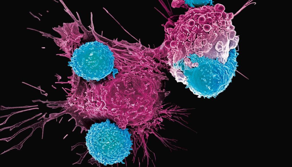 Identifican un biomarcador que predice la eficacia de la terapia CAR T 
