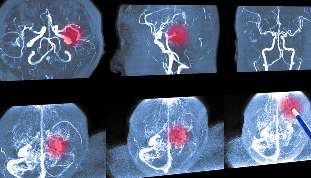 Los exosomas explican la relación entre el herpes zóster y el ictus 