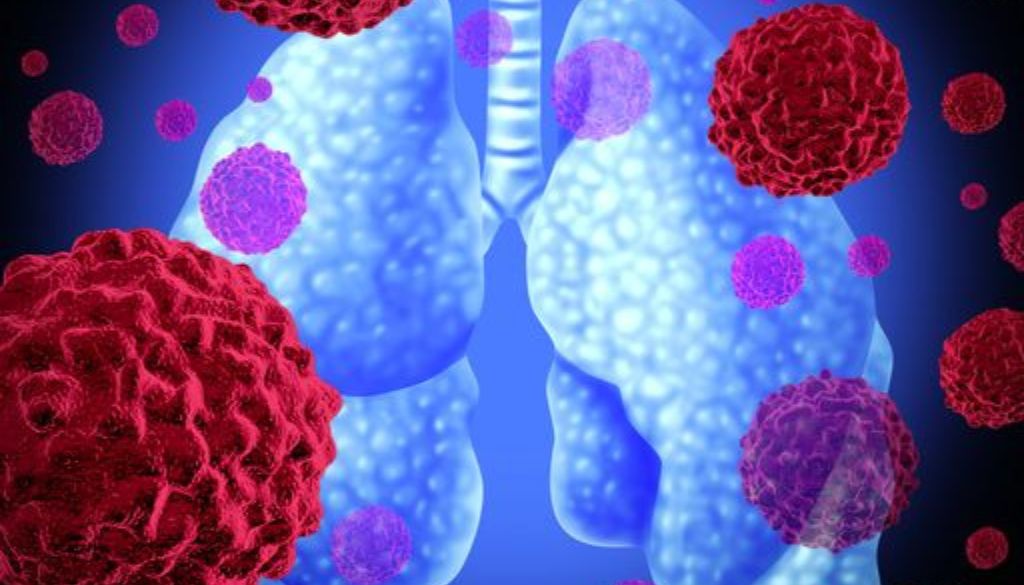 Estudio revela cáncer de pulmón afecta salud sexual del 60 % de los pacientes 