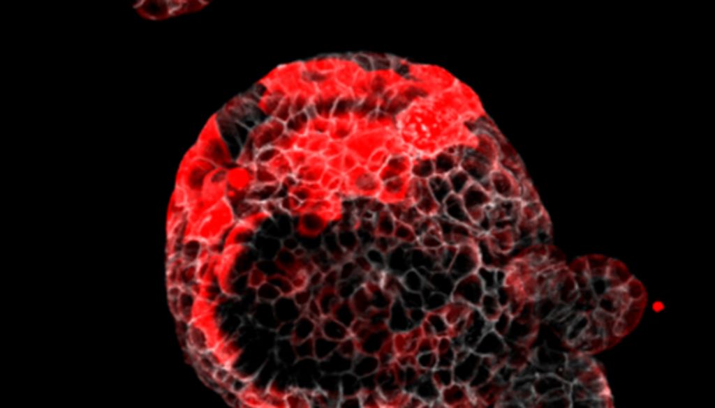 Identificadas células responsables de la recaída en el cáncer de colon 