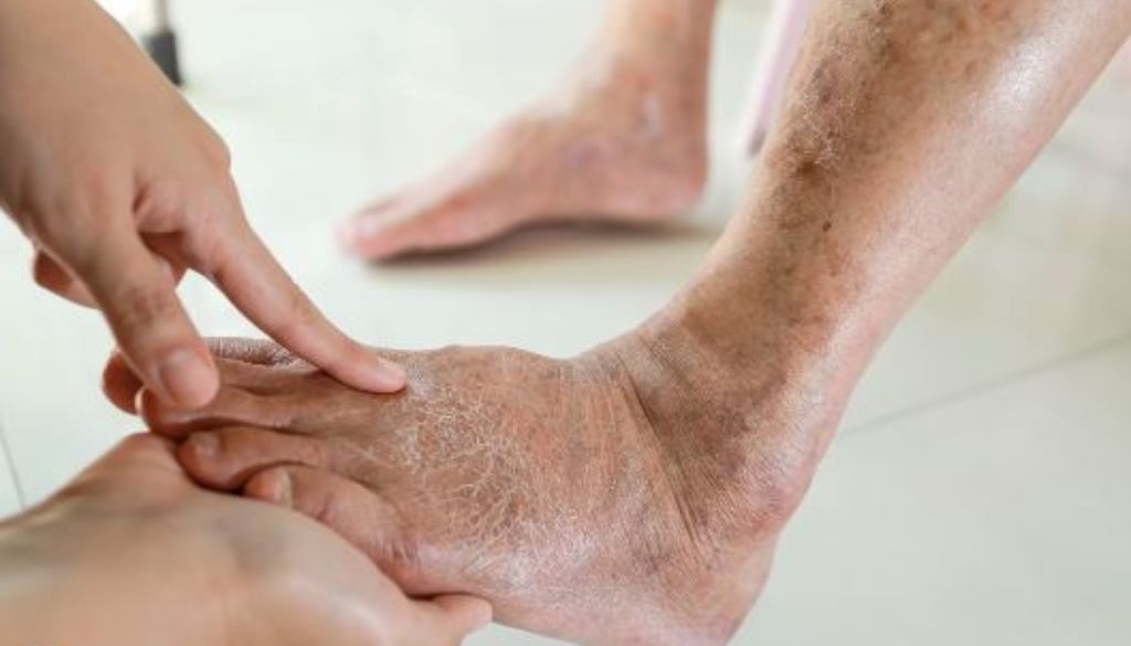 Sociedades médicas fortalecen manejo integral del pie diabético en el Norte 