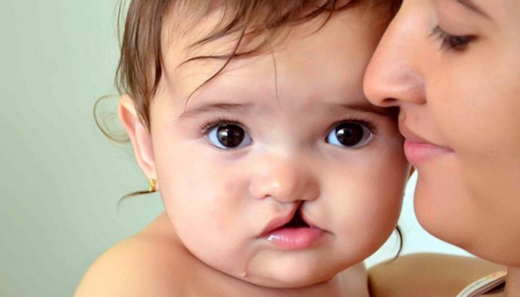 Anuncian 38.ª Jornada Quirúrgica Internacional para pacientes con labio y paladar hendido 