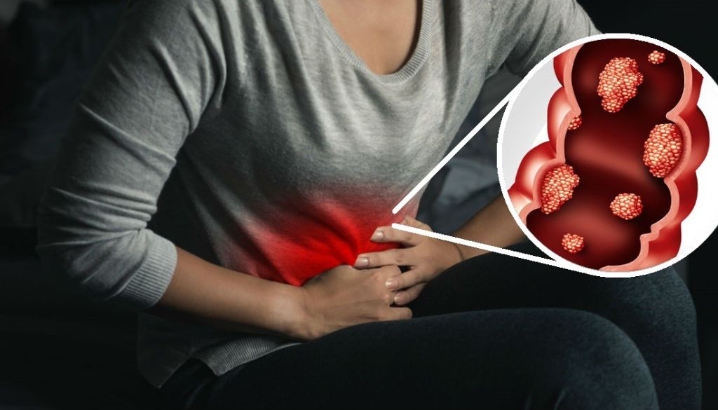 Cáncer colorrectal afecta cada vez más jóvenes 