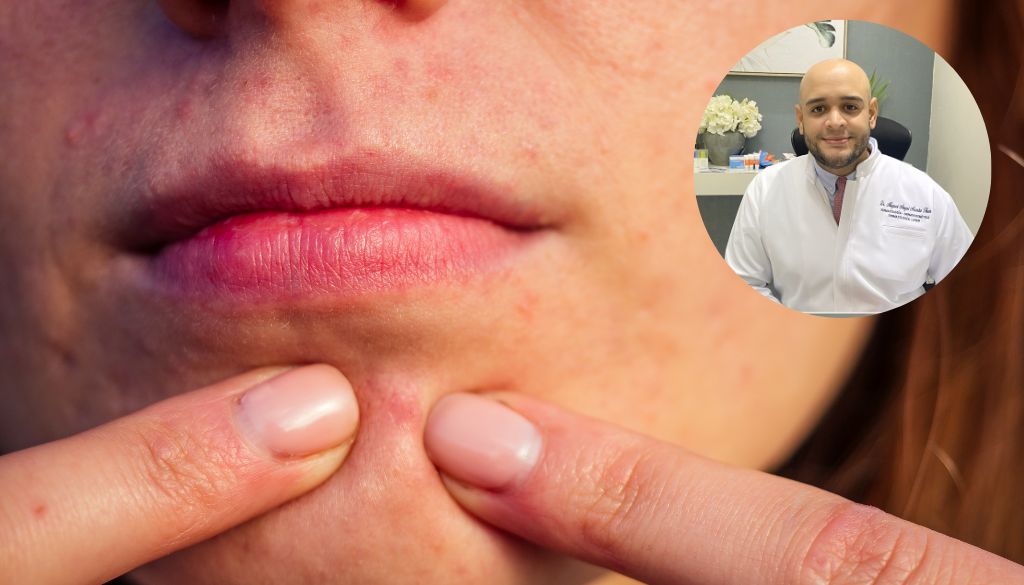 Especialista advierte calor en el país puede activar de manera severa el acné 