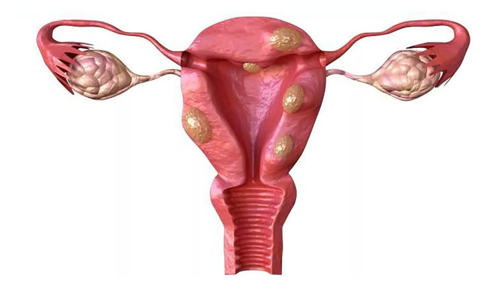 Publican primera guía de sarcomas uterinos 