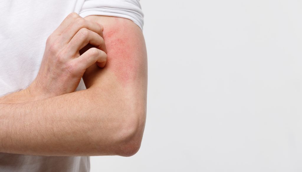 Destacan impacto social y emocional de la dermatitis atópica  