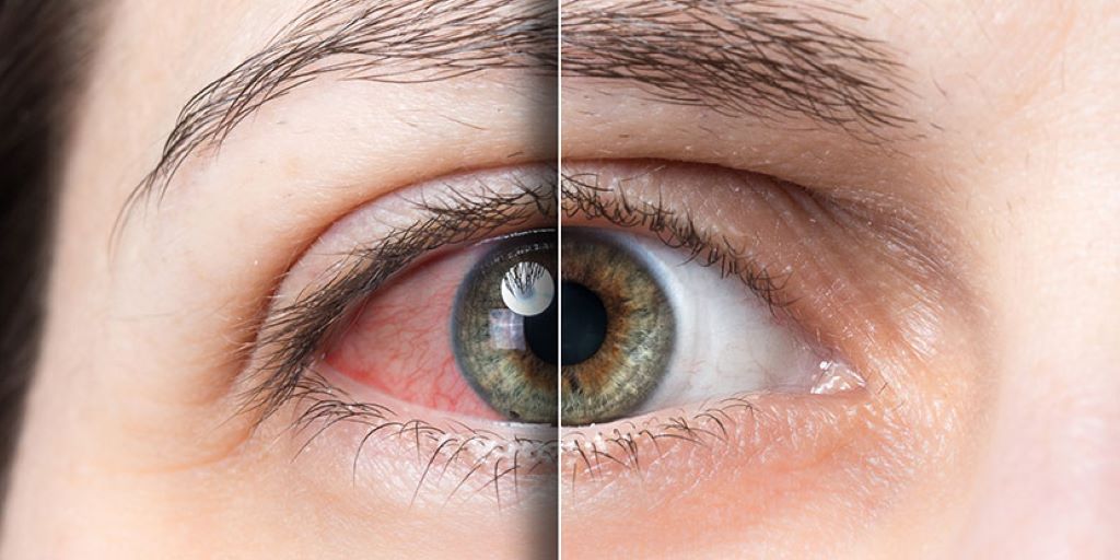 Síndrome de ojo seco, enfermedad multifactorial que afecta la calidad de vida 