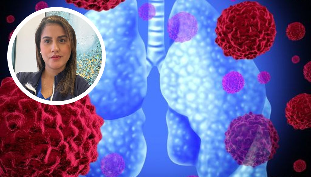 Neumóloga destaca principales síntomas Cáncer de Pulmón 