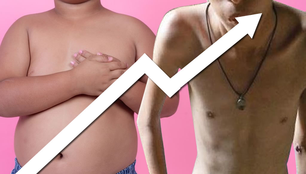 Preocupa altos indicadores en desnutrición y obesidad  infantil 