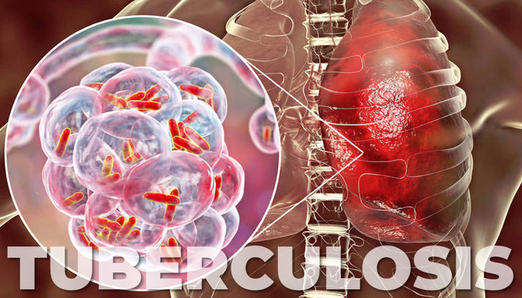 Revelan tuberculosis multirresistente sigue siendo una crisis de salud pública  